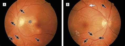 birdshot chorioretinopathy symptoms.